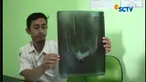 Wawan mengaku telah memakan paku sekitar 6 bulan terakhir dan keluarga menyadari setelah ada paku yang melukai usus.