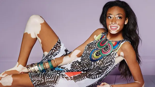 20151023-Stok Ilustrasi Vitiligo