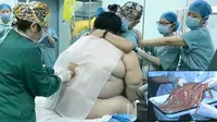 Dikira Hamil, Cacing Pita 7,7 Meter Bersarang di Tubuh Wanita Ini
