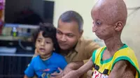 Remaja 14 Tahun Ini Menua dengan Sangat Cepat