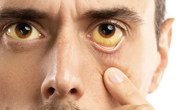 5 Fakta Hepatitis A, Penyakit yang Sedang Mewabah di Pacitan