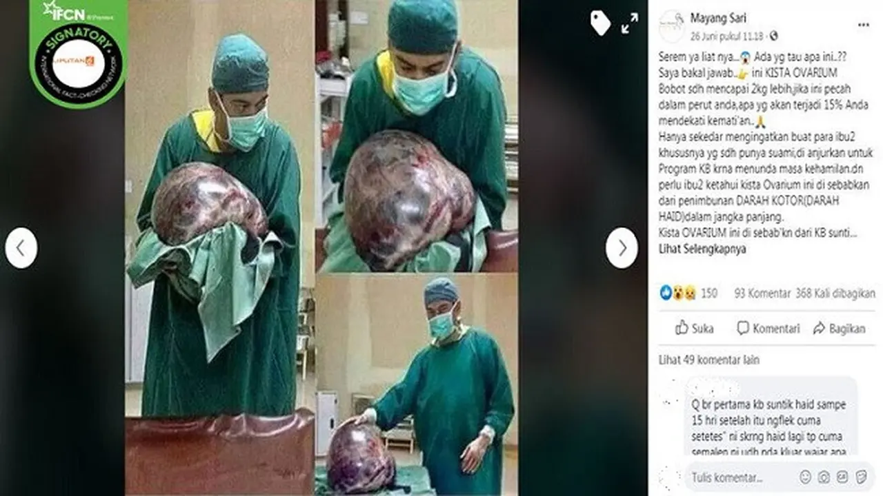 Gambar Tangkapan Layar Foto Kista Ovarium