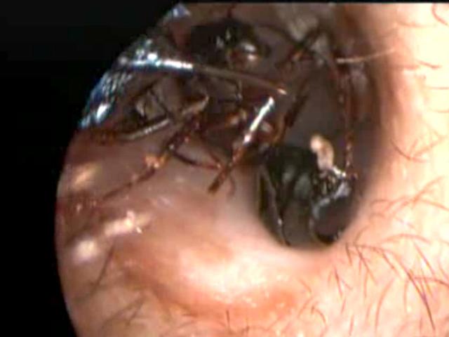 Hiii Ribuan Semut Bersarang Di Telinga Bocah Ini Global Liputan6 Com