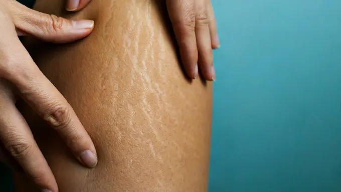 Ilustrasi stretch mark