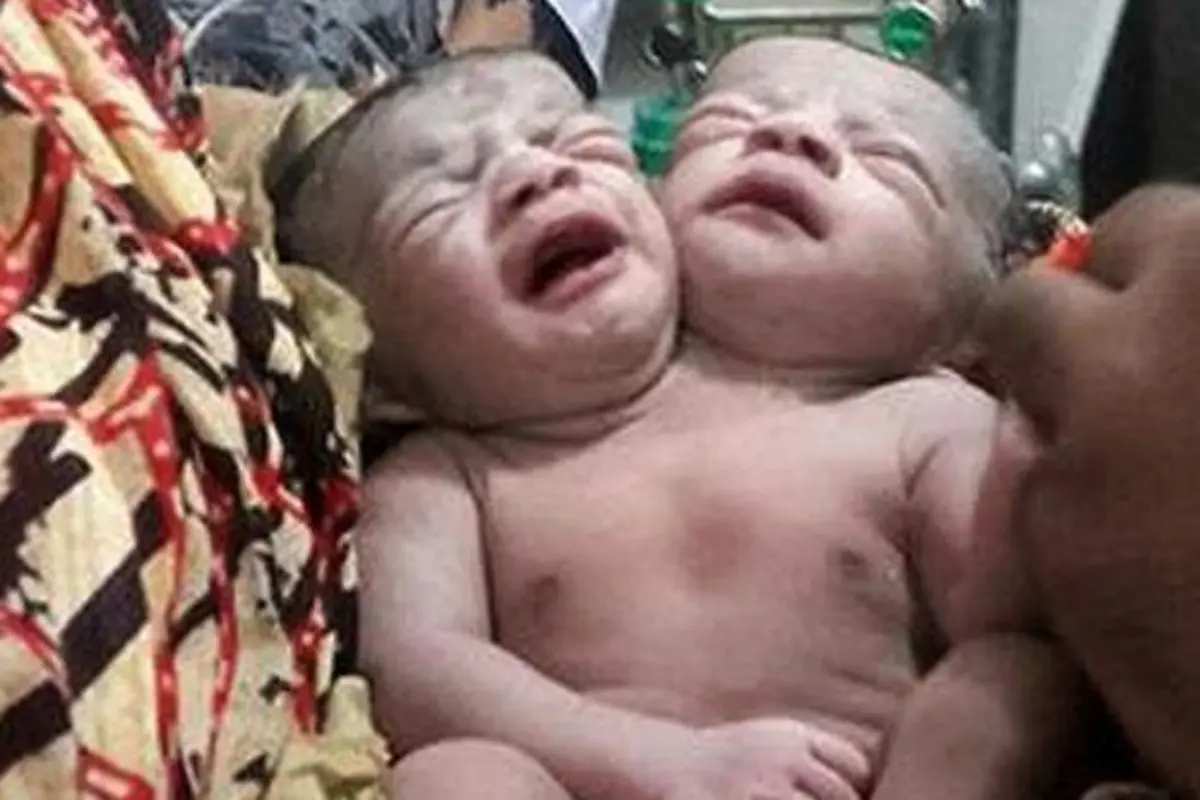 Bayi Berkepala Dua Lahir Buat Heboh Publik Bangladesh