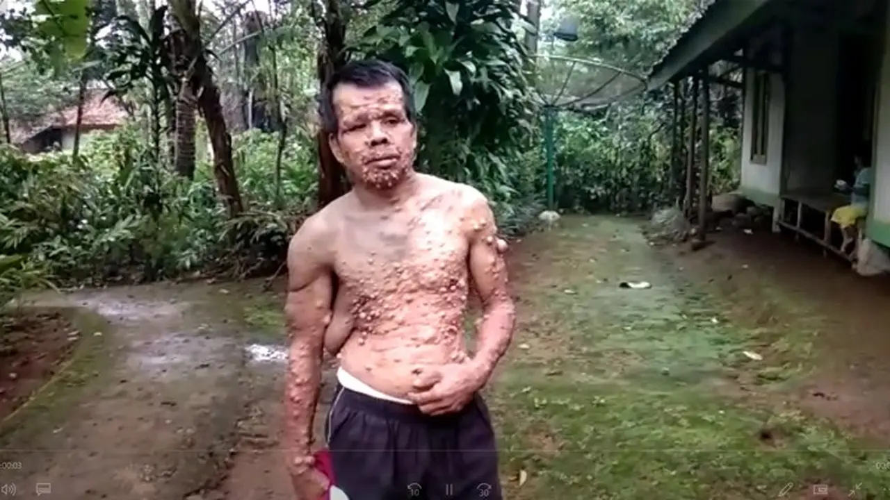 Teten, Pria dengan Kutil di Sekujur Tubuh