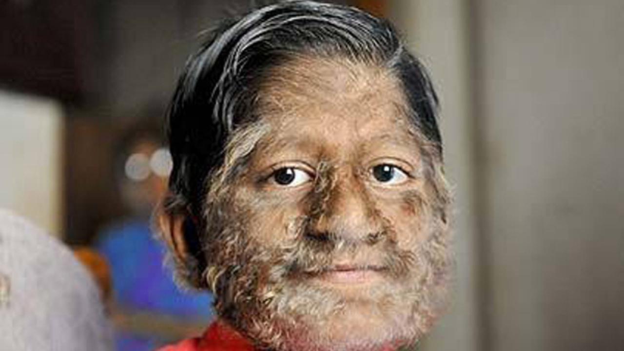 Penyakit Aneh dan Langka di Dunia