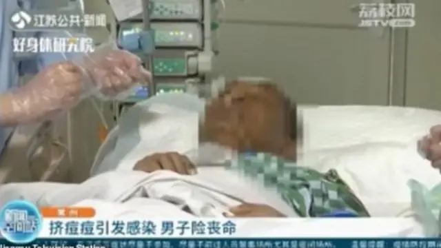 Pencet Jerawat di Dekat Bibir, Pria Ini Hampir Meninggal Dunia