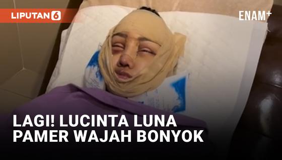 VIDEO: Lucinta Luna Pamerkan Wajah Bonyok Pasca Operasi Rahang dan Tulang Ekor