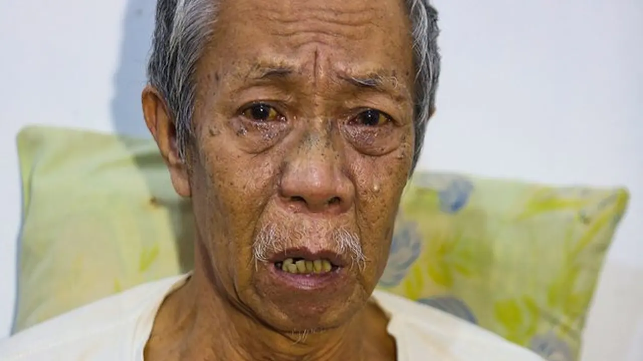 6 Potret Terbaru Pak Ogah Si Unyil, Kini Idap Penyakit Penyumbatan Pembuluh Darah Otak