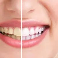 Ketika mendapati gigi Anda tampak kuning setiap kali tersenyum terkadang dapat membuat Anda sangat frustasi