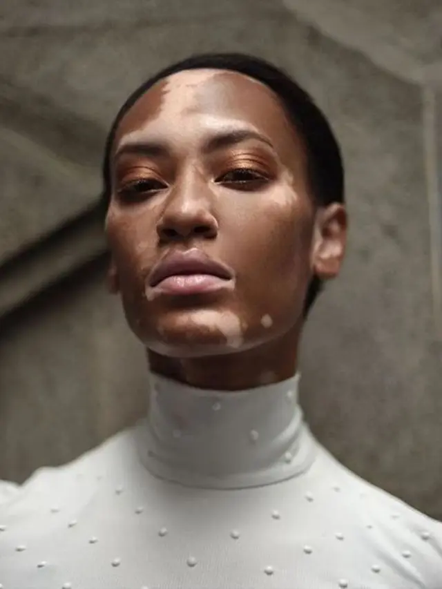 [Bintang] Menderita Vitiligo, Amy Deanna Berhasil Jadi Model yang Mendunia