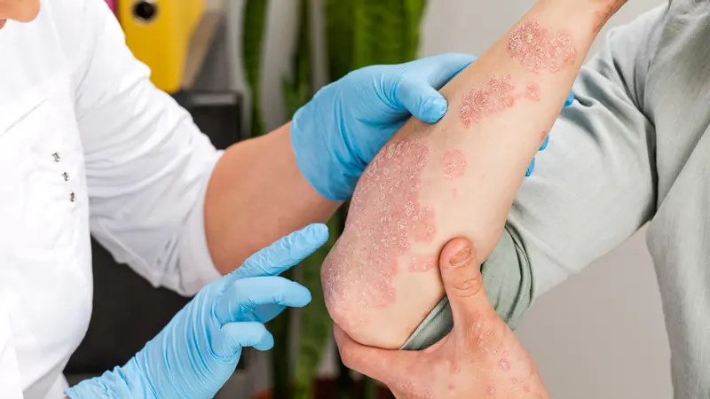 4 Perawatan Kulit untuk Penderita Psoriasis, Mengurangi Iritasi dan Memperbaiki Kondisi Kulit