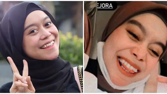 6 Beda Gaya Lesti Kejora Sebelum vs Sesudah Pakai Behel, Hilangkan Gingsul