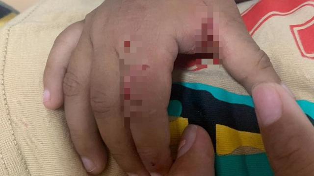 Bocah korban gigitan ikan aligator