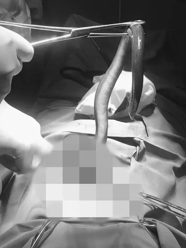 Alami Kondisi Darurat, Dokter Ini Temukan Belut Hidup 30 CM di Perut Seorang Pria
