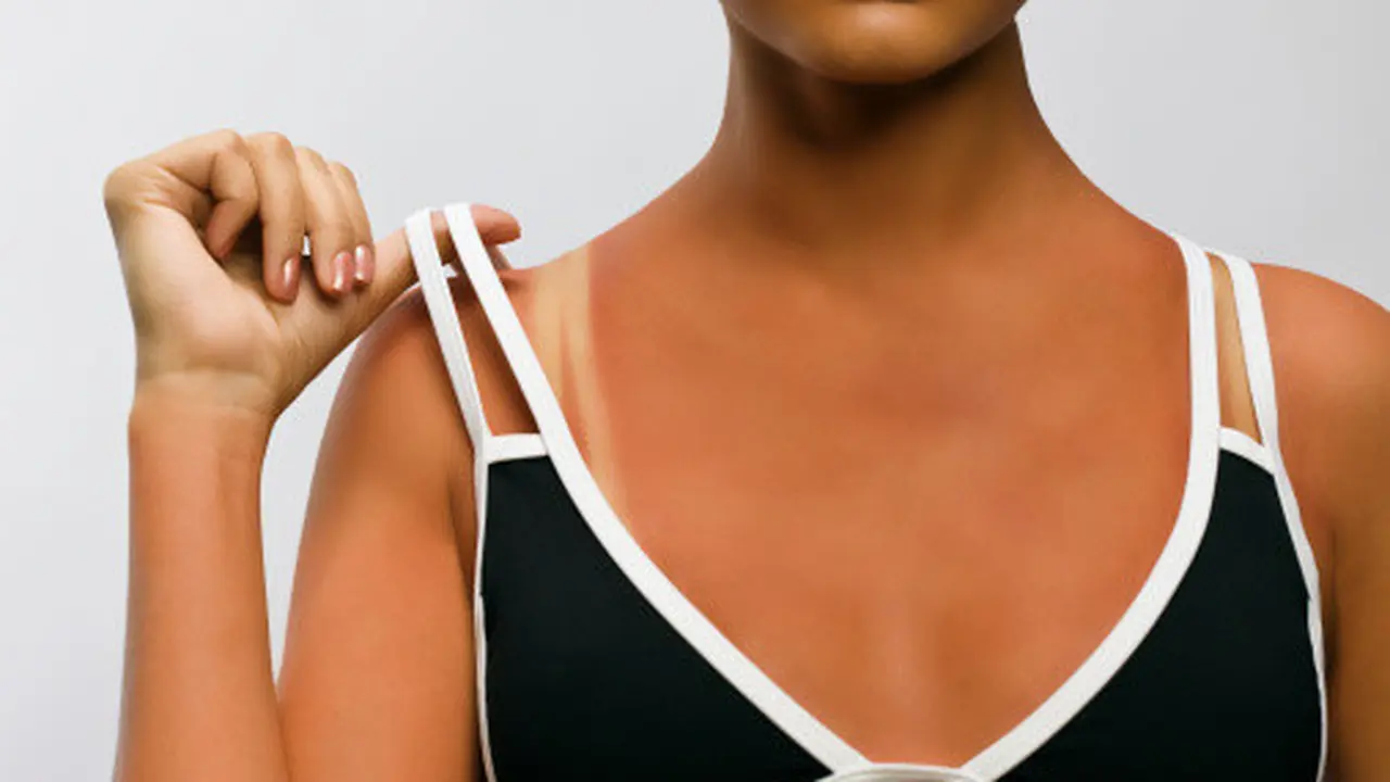 Obat Baru untuk Sunburn