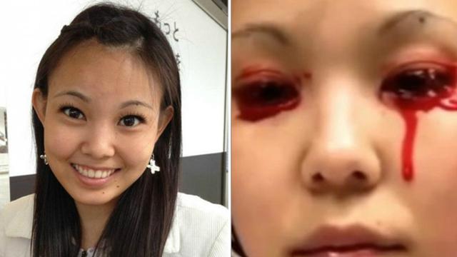 Darah Sering Mengucur Dari Mata Dan Lidah Wanita Cantik Ini Health Liputan6 Com