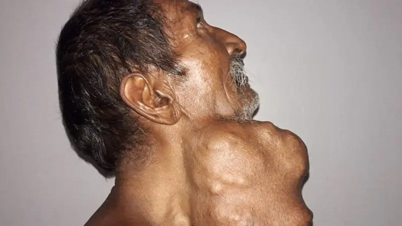 Dibiarkan 20 Tahun, Tumor 1,4 Kg di Kelenjar Ludah Pria Ini Akhirnya Diangkat