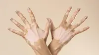 Cara Baru Atasi Bercak Vitiligo, Teknologi Fototerapi Bantu Tingkatkan Rasa Percaya Diri Peyintas