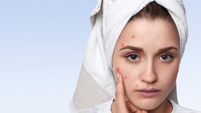 Ilustrasi wajah berjerawat