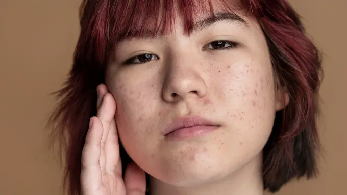 Bingung Antara PIE dan PIH? Ini Cara Mudah Membedakannya dan Memilih Skincare yang Tepat - Cover