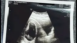 7 hari setelah periksa ke dokter kandungan pada awal Oktober lalu, Via membuka fakta kepada publik bahwa ia sedang hamil. Namun kondisi kandungannya bermasalah. (instagram.com/viavallen)