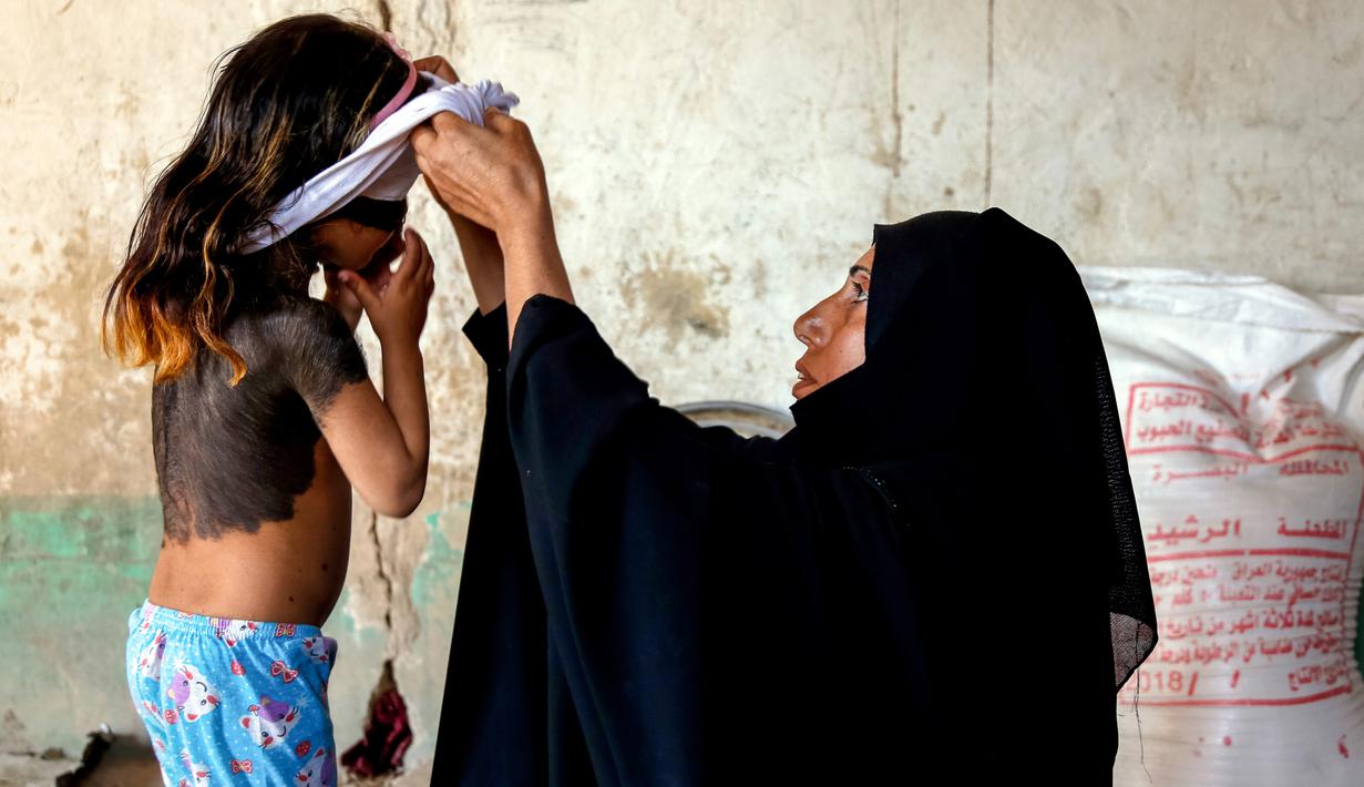 Ibu Houra memakaikan baju di rumahnya di desa Wahed Haziran, Provinsi Diwaniya, Irak, (17/3). Penyakit langka yang diidap Houra sejak lahir ini membuat Houra menjadi bahan cemoohan warga di desanya. (AFP Photo/Haidar Hamdani)