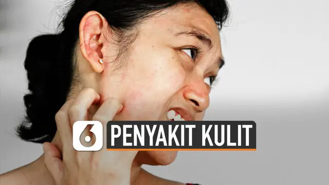 VIDEO: Waspada Penyakit Kulit yang Menyerang di Musim Hujan