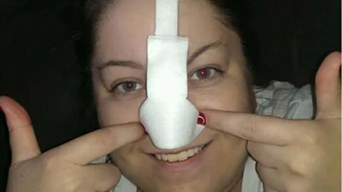 Karena Kanker Kulit, Perempuan Ini Punya Hidung Berbulu Lebat