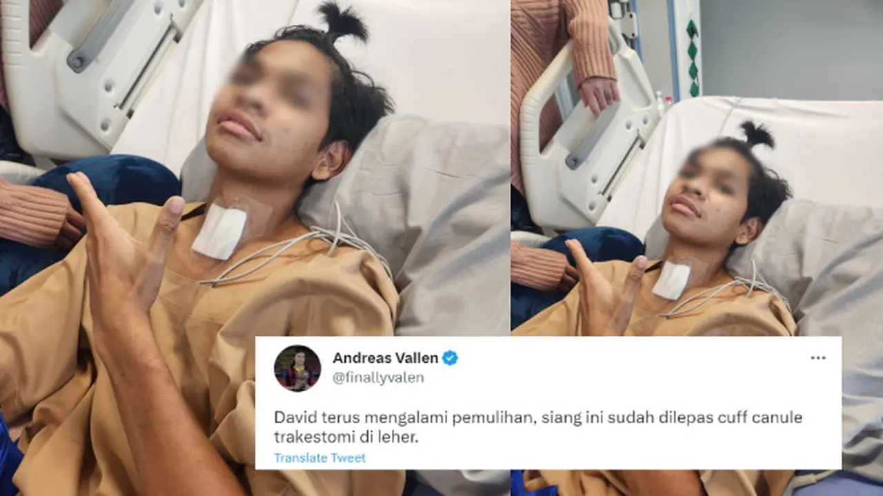 Kondisi Terkini David Ozora yang Dibagikan Pihak Keluarga. Dokter Akhirnya Melepas Selang Kanul Trakeostomi dari Leher Korban Penganiayaan Mario Dandy, Shane, dan AG (twitter.com/finallyvalen)