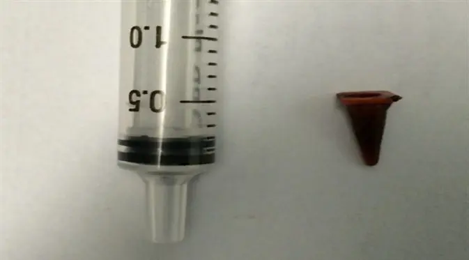 Miniatur traffic cone akhirnya dikeluarkan dari paru-paru Paul. (Foto: Biomedical Journal Case Reports)