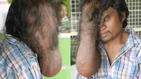 Berkat Wisatawan Dermawan, Pria Berbelalai Gajah Akan Dioperasi