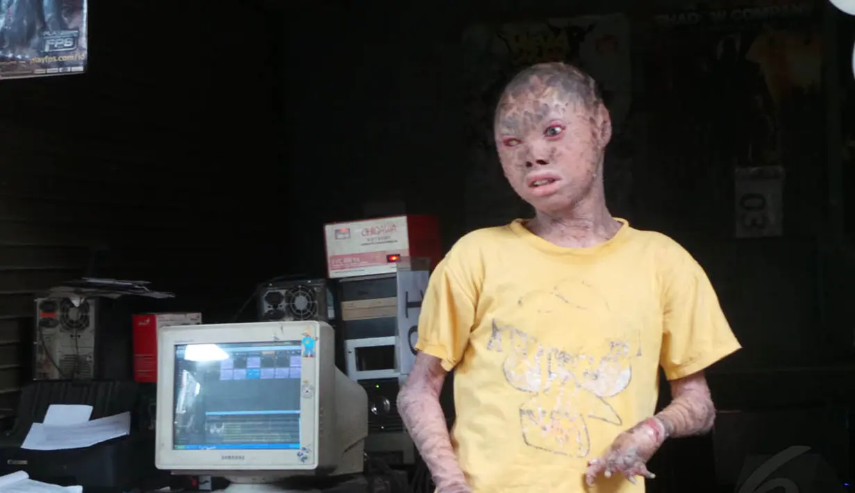 Ari Wibowo, remaja 16 tahun asal Tangerang yang memiliki kelainan kulit. (Liputan6.com/Benedikta Desideria)