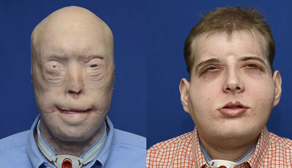 Perbedaan muka Patrick Hardison sebelum dan sesudah melakukan bedah plastik di Langone Medical Center NYU, New York, Amerika Serikat, (16/11/2015). Diperkirakan total biaya mencapat 1 juta dollar. (REUTERS)