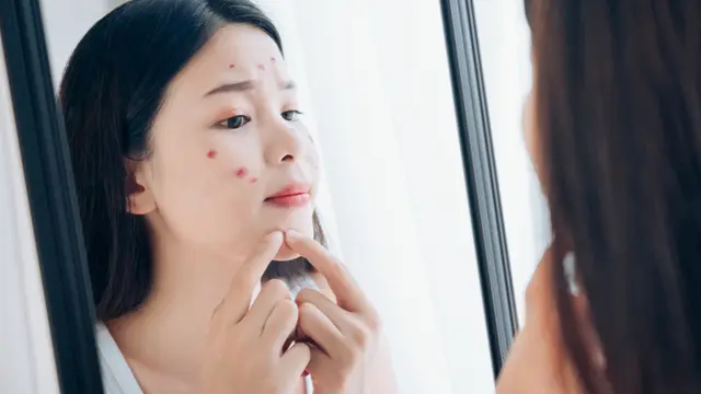 Ilustrasi jerawat meradang