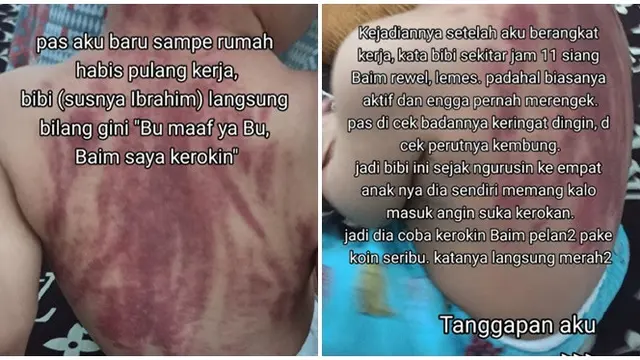 Viral Ibu Curhat Anaknya Berusia 13 Bulan Dikerok Baby Sitter, Netizen Ikut Kritik