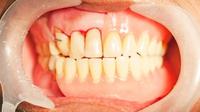 Mengenal Periodontitis 