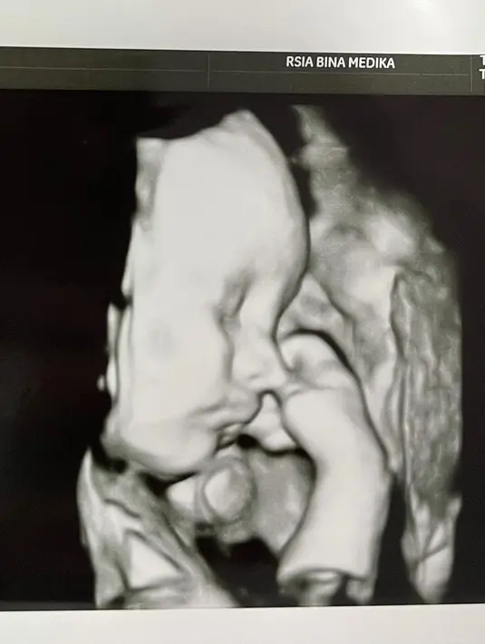 Seperti diberitakan sebelumnya, Audy Marissa melahirkan anaknya di usia 31 minggu atau sekitar delapan bulan. Anthoni Xie pun masih tidak tega melihat bayinya yang lahir secara prematur tersebut. (Instagram/anthonyxie_)