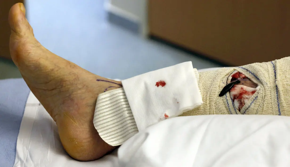 Lintah ditempatkan pada bagian kaki yang mengalami sakit saat terapi di rumah sakit CHU Pellegrin, Bordeaux, Prancis, (23/11). Lintah untuk terapi ini menggunakan lintah jenis Hirudo Medicinalis. (REUTERS / Regis Duvignau)