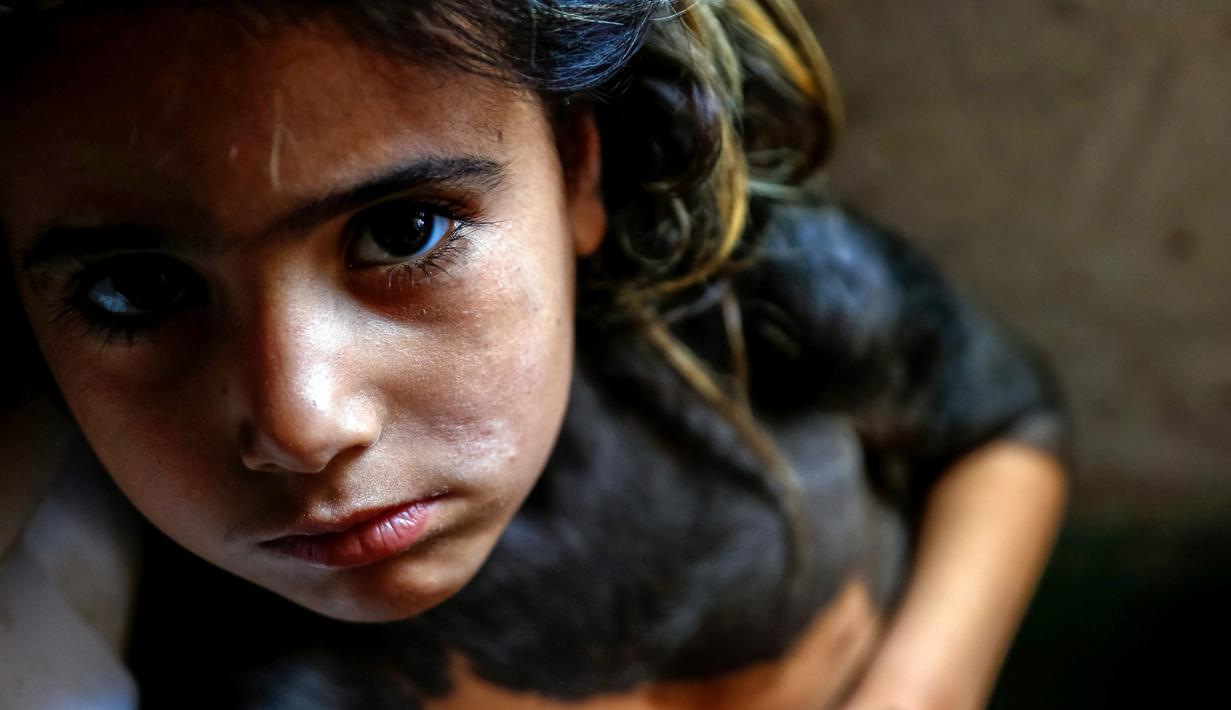 Houra bocah empat tahun yang mengidap penyakit kulit langka dengan bercak hitam dan rambut menutupi bagian atas tubuhnya berada di rumahnya di desa Wahed Haziran, Provinsi Diwaniya, Irak, (17/3). (AFP Photo/Haidar Hamdani)