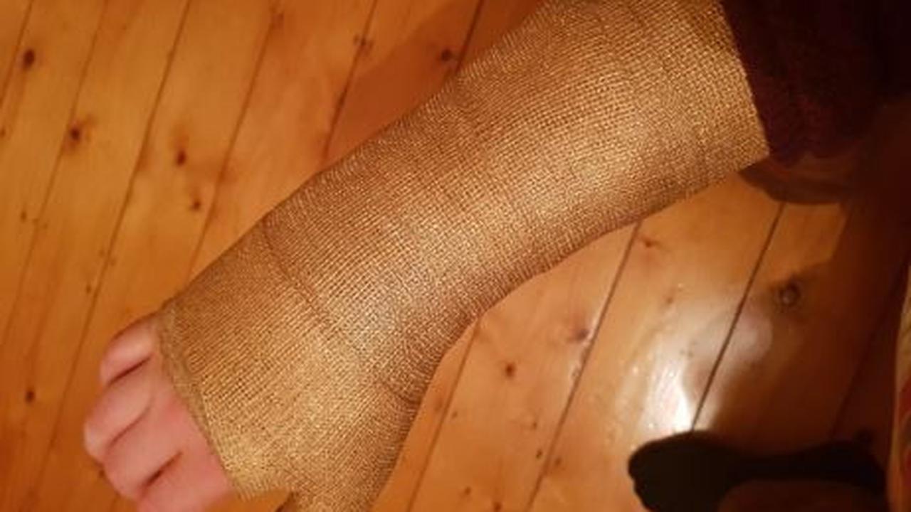 Pergelangan Tangannya Cedera, Pria Ini Gunakan Hiasan Gips yang Unik