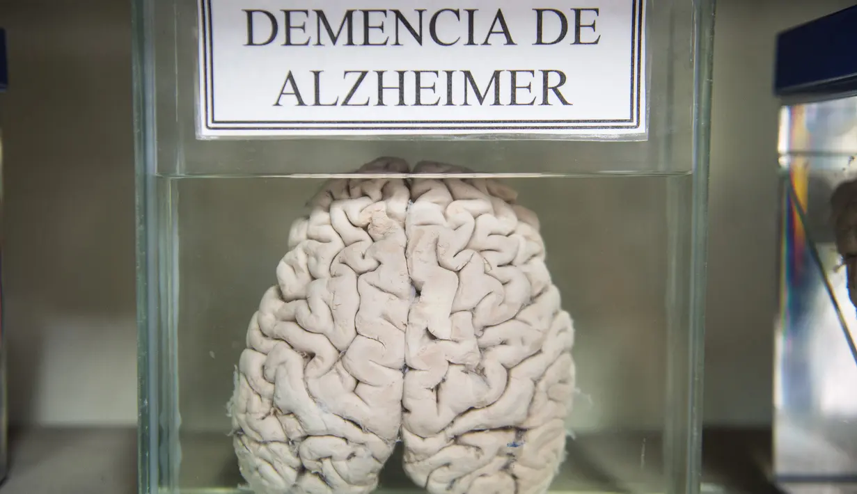Salah satu otak manusia yang diawetkan di Museum Neuropatologi, di Rumah Sakit Santo Toribio de Mogrovejo, Lima, Peru (16/11). Neuroptologi adalah adalah sebuah subspesialisasi patologi yang berhubungan dengan penyakit otak. (AFP Photo/Ernesto Benavides)