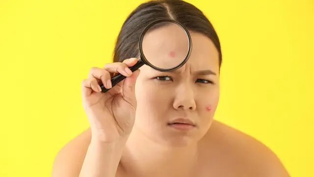 Tanda Infeksi Jerawat yang Nggak Boleh Disepelekan, Jangan Sampai Kondisinya Makin Parah!