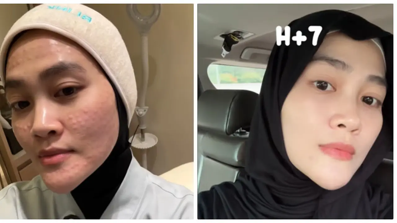 6 Potret Perubahan Wajah Henny Rahman Setelah Perawatan, Makin Cerah dan Mulus