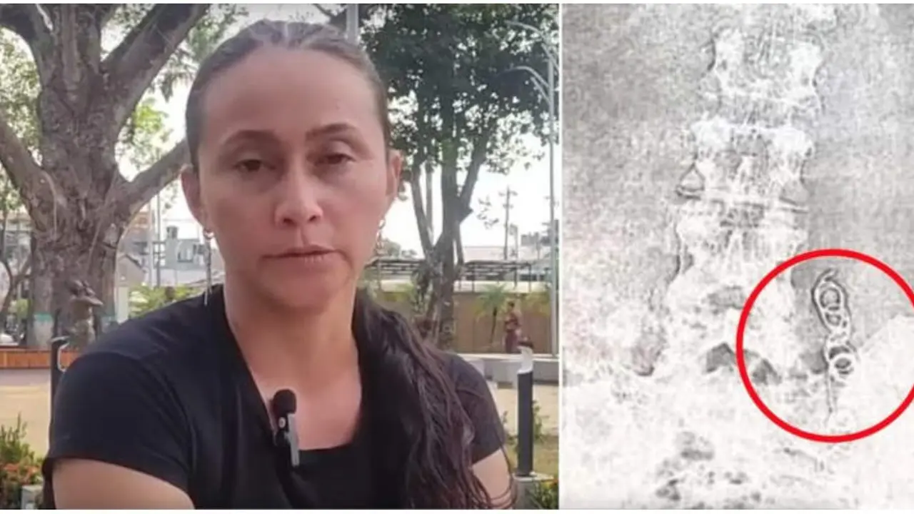 Wanita asal Kolombia yang mengeluhkan sakit perut, dan ternyata terdapat jarum bedah di perutnya (Tangkapan layar dari website odditycentral.com)