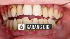 Sebelum karang gigi benar-benar muncul, berikut cara mencegahnya.