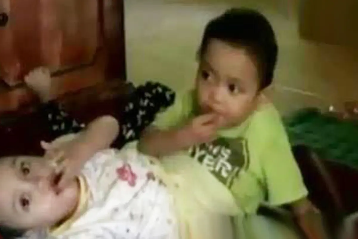 VIDEO: 2 Balita Kembar Siam Ini Hanya Punya Sepasang Kaki