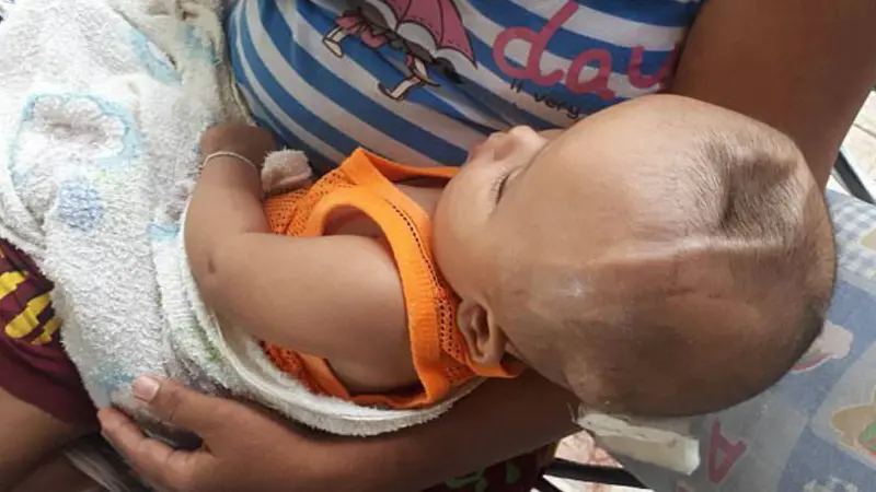 Bayi Thailand yang memiliki tulang kepala retak dan ditinggalkan orang tuanya. (Viral Press)