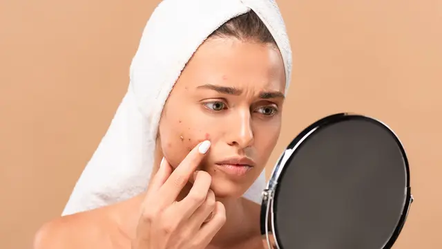 Ciri-ciri Jerawat Breakout yang Wajib Diketahui, Bagaimana Langkah Tepat untuk Mengatasinya?